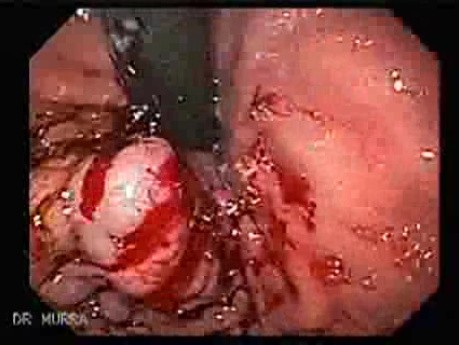 Żylaki żołądka - endoskopowa ablacja klejem cyjanoakrylowym (2 z 18)