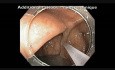 Rak okrężnicy wstępującej - biopsja i oznaczanie przed operacją