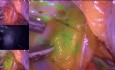 Laparoskopowe usunięcie macicy z przydatkami z procedurą węzła wartowniczego wybarwionego zielenią indocyjanową