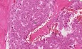Komórki nowotworowe ziarniste - Badanie histopatologiczne jajników