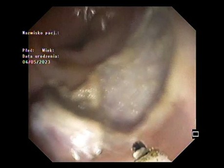 Endoskopowa submukozalna dyssekcja (ESD) z klipsowaniem miejsca resekcji