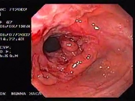 Choroba Leśniowskiego - Crohna - endoskopia (14 z 28)