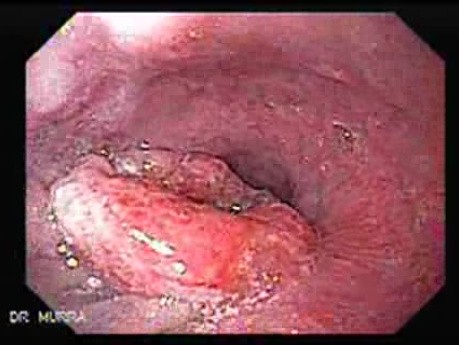 Rak gruczołowy wpustu i dna żołądka (1 z 2)