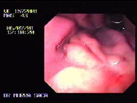 Wczesny rak żołądka z komórkami sygnetowatymi - endoskopia (2 z 3)