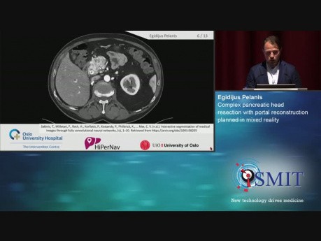 Złożona resekcja głowy trzustki z rekonstrukcją żyły wrotnej zaplanowana w rzeczywistości mieszanej (mixed reality) - SMIT 2019