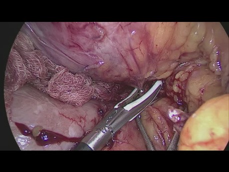 Laparoskopowe całkowite wycięcie krezki okrężnicy i limfadenektomia D3 z powodu guza zagięcia wątrobowego