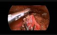 Laparoskopowe zszycie perforacji żołądka