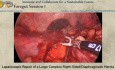 Réparation Laparoscopique d'une Volumineuse Hernie Diaphragmatique Complexe Droite