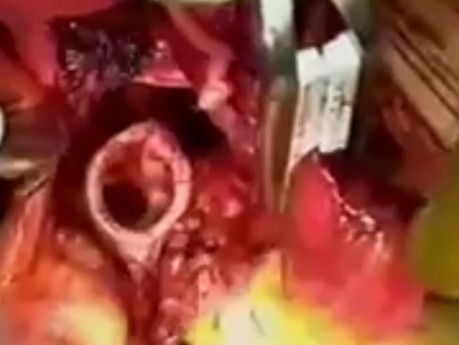 Przeszczep prawego płuca z jednoczesną transplantacją serca