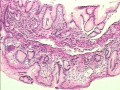 Drobnokomórkowy rak płuc naciekający górną i środkową część przełyku (5 z 7)