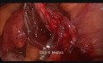 Laparoskopia w endometriozie 