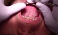 Przypadek Ortodontyczny #1 - Obecnie 10 miesięcy Stosowania Aparatu Stałego