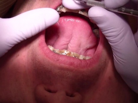 Przypadek Ortodontyczny #1 - Obecnie 10 miesięcy Stosowania Aparatu Stałego