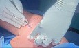 Hemiartroplastyka stawu barkowego z resurfacingiem