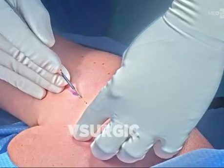 Hemiartroplastyka stawu barkowego z resurfacingiem