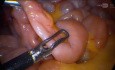 Récupération laparoscopique de la capsule d'endoscopie