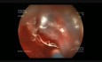 Endoskopowa dyssekcja podśluzówkowa guza esiczo-odbytniczego 