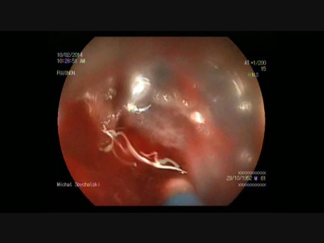 Endoskopowa dyssekcja podśluzówkowa guza esiczo-odbytniczego 