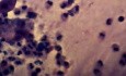 Zapalenie szyjki macicy - Komórki jeżowe