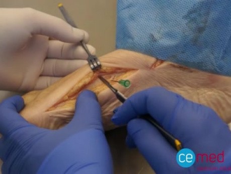 Techniki operacyjnego leczenia deformacji przodostopia – paluch koślawy, deformacje palców. Kurs na preparatach nieutrwalonych.