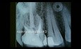 Mikrochirurgia periodontologiczna: ekstrakcja i przygotowanie miejsca przeszczepu kości pod implant trzonowca