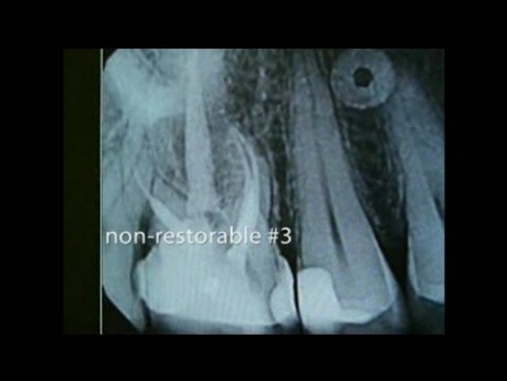 Mikrochirurgia periodontologiczna: ekstrakcja i przygotowanie miejsca przeszczepu kości pod implant trzonowca