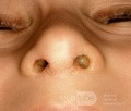 Jednostronny wyciek z nosa spowodowany ciałem obcym