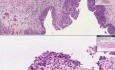 Pęcherz moczowy - rak in situ z komórek urotelialnych (transitional cell carcinoma)
