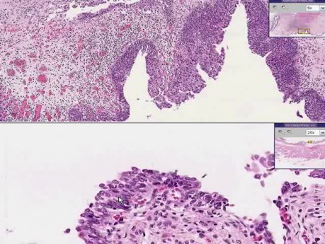 Pęcherz moczowy - rak in situ z komórek urotelialnych (transitional cell carcinoma)