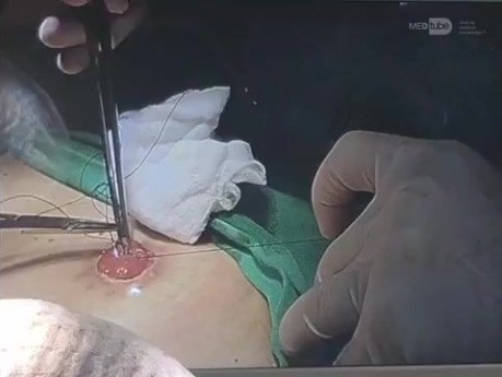 Laparoskopowe przywrócenie ciągłości jelita po procedurze Hartmanna