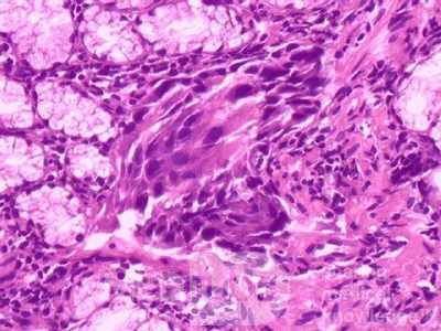 Przerzuty z raka jajnika do żołądka i dwunastnicy (14 z 20)