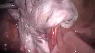 Laparoskopowe wycięcie torbieli jajnika