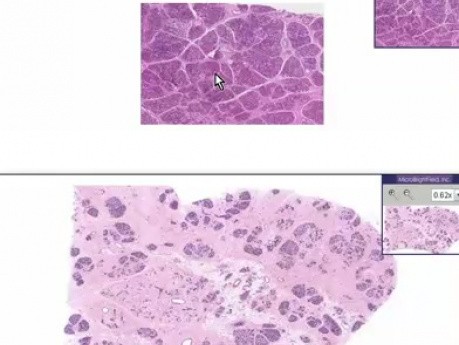 Hiperplazja podczas laktacji - histopatologia - pierś