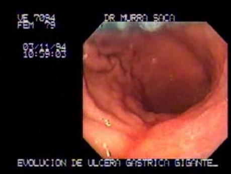 Duży rozgałęziony wrzód żołądka, wrzody żołądka (3 z 3)