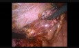 Laparoskopowe wyłuszczenie guza jajnika podczas ciąży