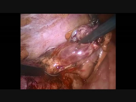 Laparoskopowe wyłuszczenie guza jajnika podczas ciąży