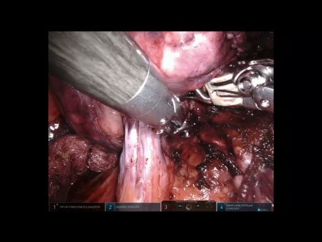 Operacja anatomicznego usunięcia segmentu płuca. 