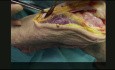 Extensile Medial Parapatellar Approach