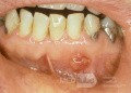 Ziarniniak i ropień korzenia zęba