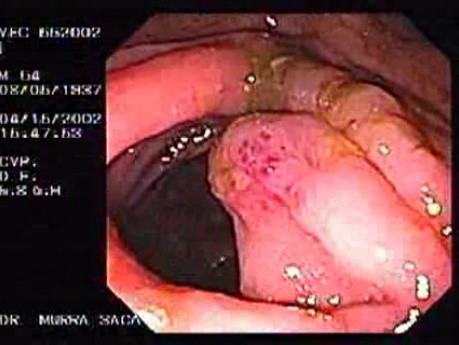 Zespół Zollingera-Ellisona - wrzód żołądka, wrzody żołądka i przetoka żołądkowo-okrężnicowa (6 z 21)