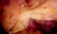 Laparoscopic Sigmoid Resection with Vena Cava Patch Resection for T4 Sigmoid Cancer
