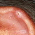 Chondrodermatitis nodularis helicis (bolesny guzek ucha)