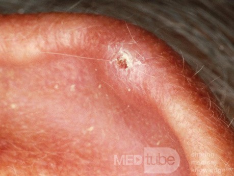 Chondrodermatitis nodularis helicis (bolesny guzek ucha)