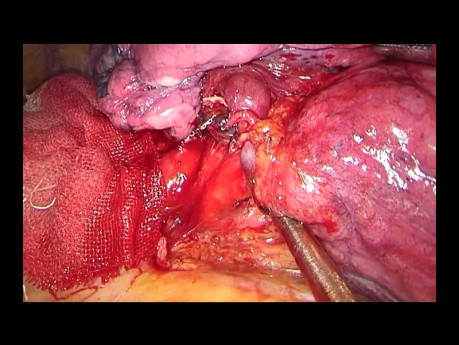 Wideotorakokopowa lewa górna lobektomia z jednego cięcia w technice fissure-less (FILM NIE EDYTOWANY)