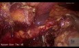 Laparoskopowa hemikolektomia prawostronna z powodu perforacji zapalenia uchyłków jelita grubego