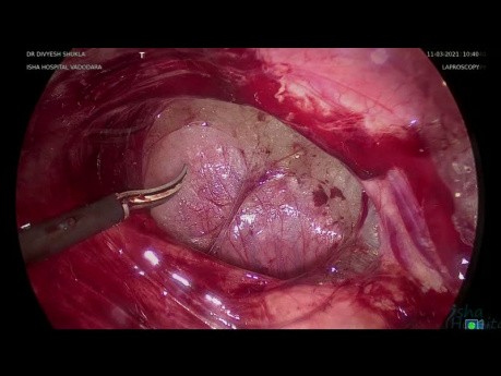 Laparoskopowa salpingektomia lewostronna z uwalnianiem zrostów z powodu wodniaka jajowodu - część 1