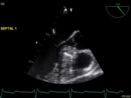 Leczenie kardiomiopatii przerostowej obstrukcyjnej -  alkoholowa ablacja tętnicy septalnej 