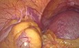 Laparoskopowy okrężny szew szyjki macicy w 14 tygodniu ciąży u pacjentki z niekorzystną przeszłością położniczą (NPP), niepowodzeniem IVF