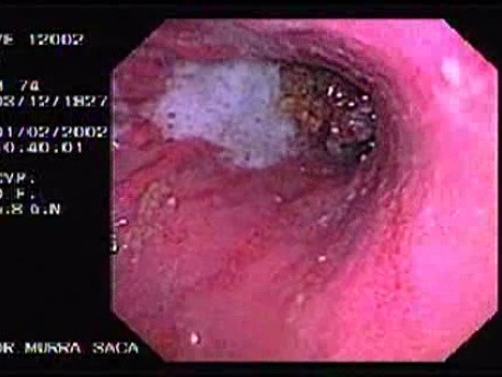 Rak trzonu żołądka - endoskopia
