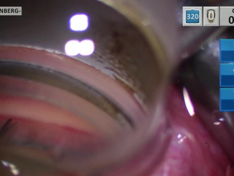 Implantacja mikrostentu jaskrowego do górnego kwadrantu